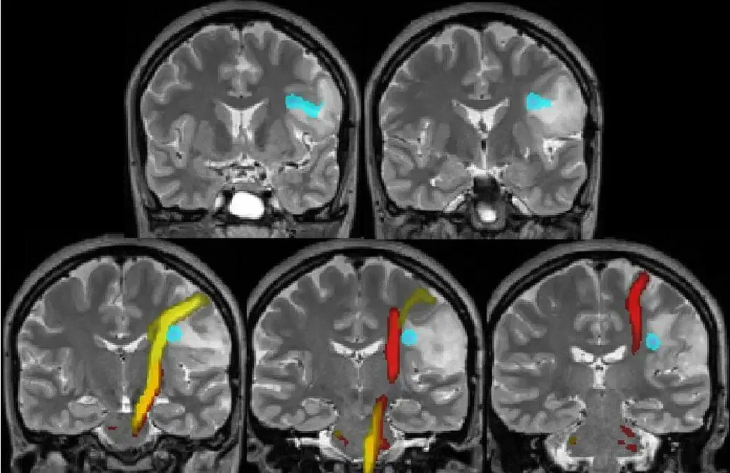 example of fMRI imaging